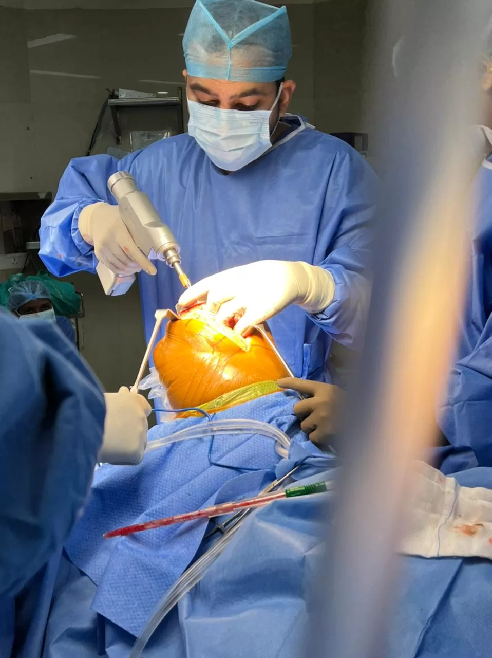Surgery Performed by Dr. Romil Rathi