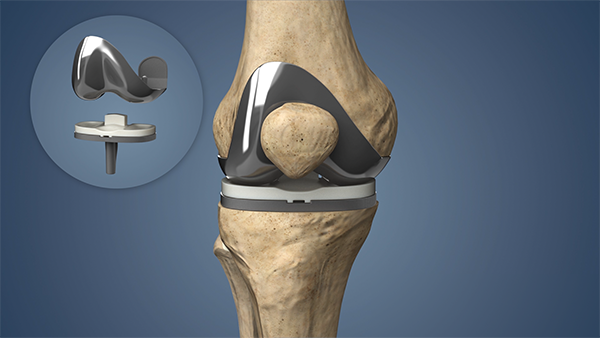Advanced knee replacement surgery Nagpur