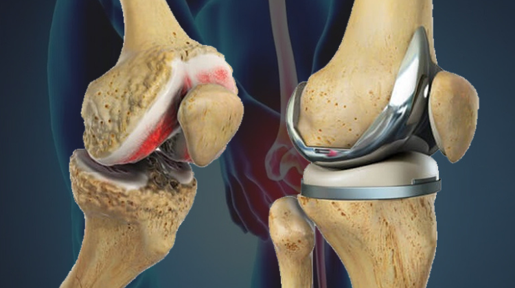Affordable knee replacement Nagpur