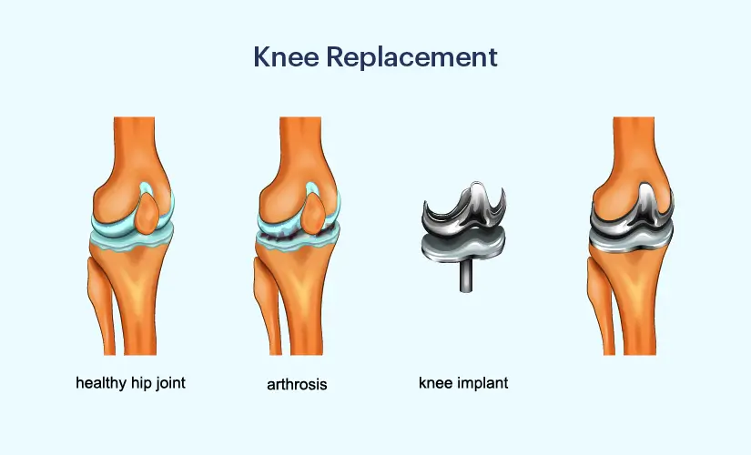 Knee replacement surgery cost Nagpur