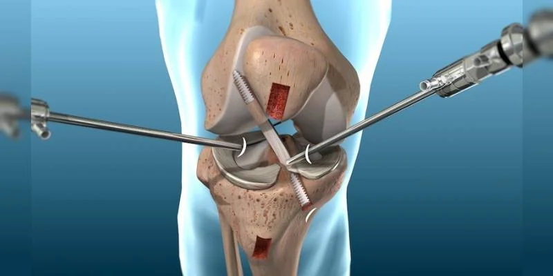 Minimally invasive knee replacement Nagpur