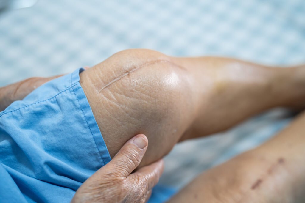 Robotic knee replacement recovery time Nagpur