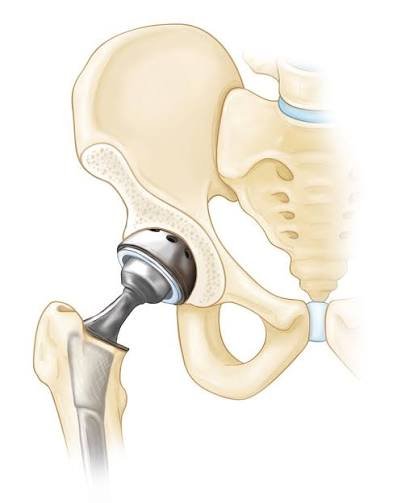 AVN Treatment in Seoni
