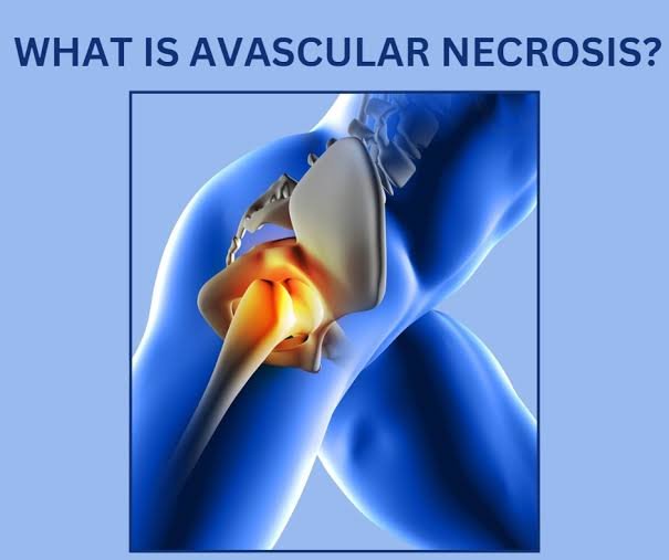 AVN treatment Amravati