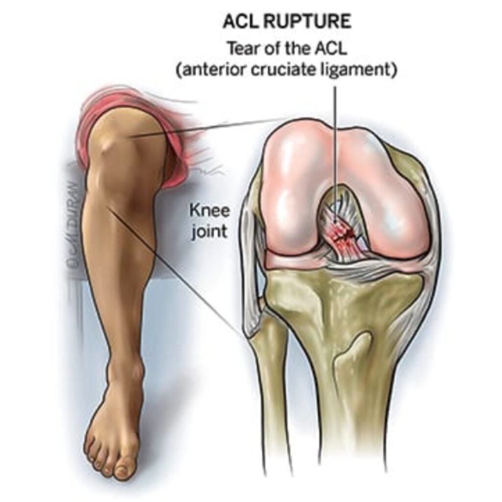 Acl ligament treatment Amaravti