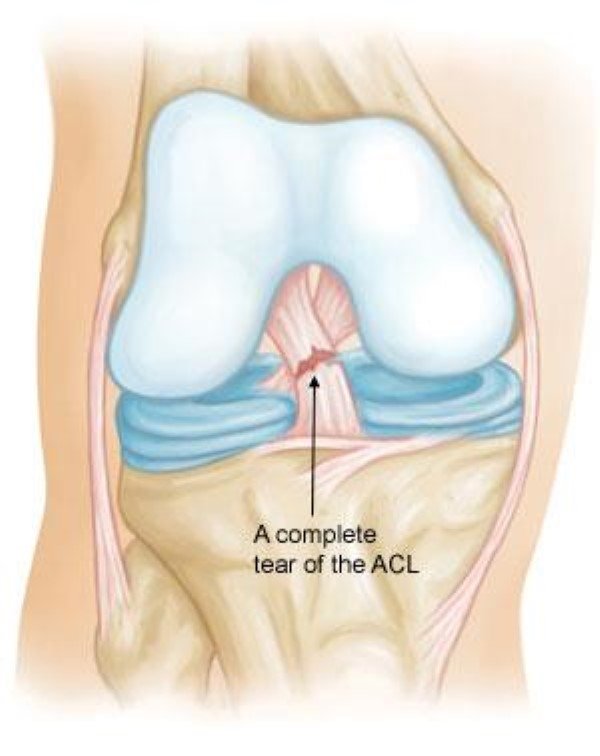 Acl ligament treatment Bhopal