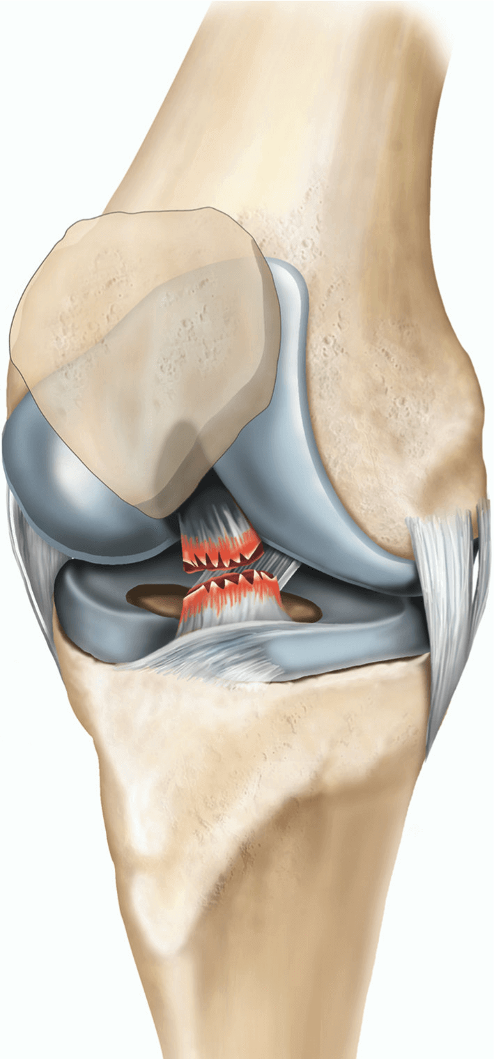 Acl ligament treatment Katni