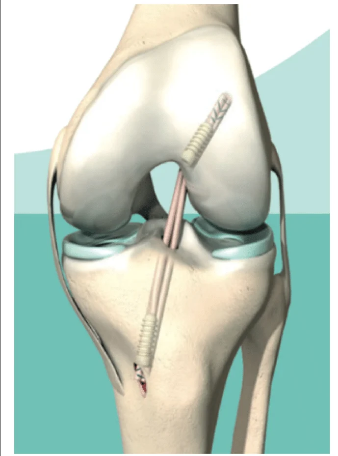 Acl ligament treatment Mandla