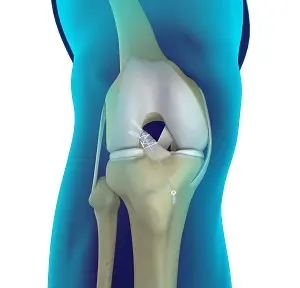 Acl ligament treatment Sagar