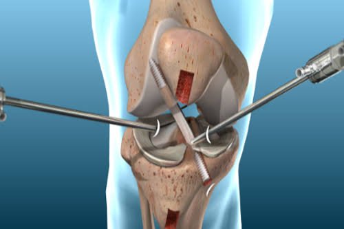 Acl ligament treatment in Satna​