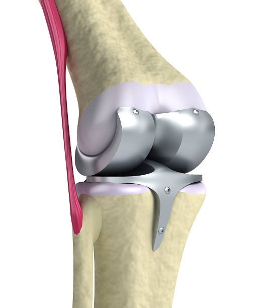 Affordable knee replacement Nagpur
