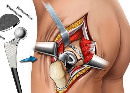 Best hip replacement in nagpur