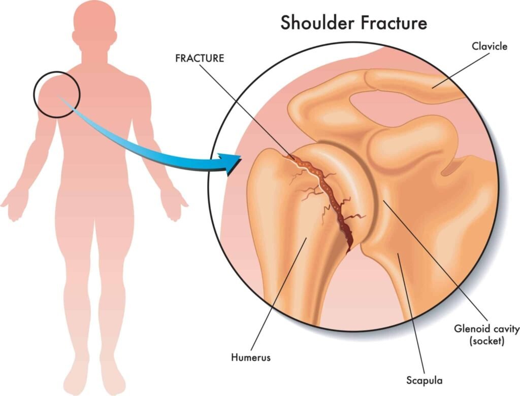 Best shoulder fracture in nagpur