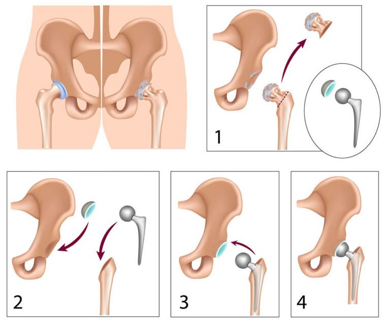 Hip Replacement In Nagpur