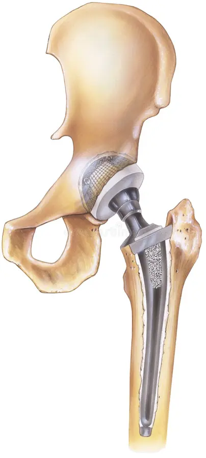 Hip replacement Adilabad