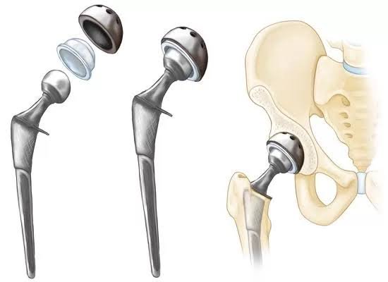 Hip replacement Betul