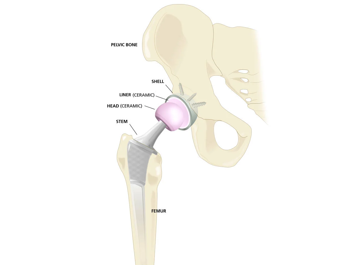 Hip replacement Bhandara