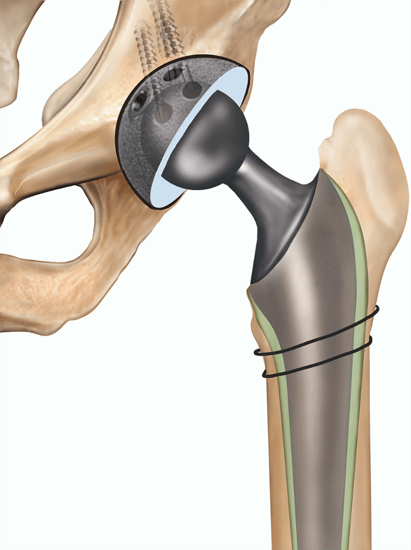Hip replacement Bhopal