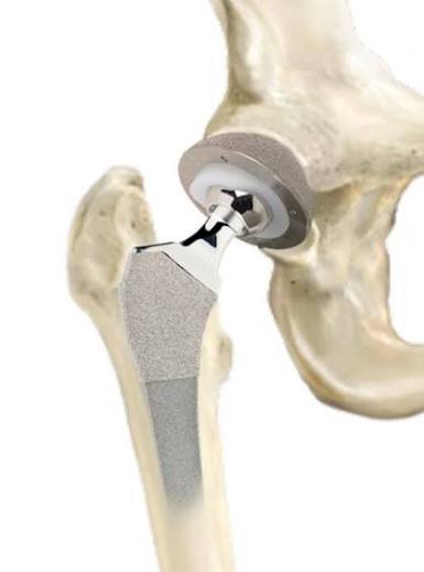 Hip replacement Harda