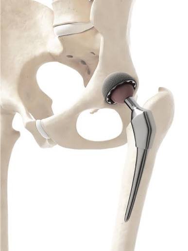 Hip replacement Hoshangabad