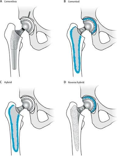 Hip replacement Itarsi