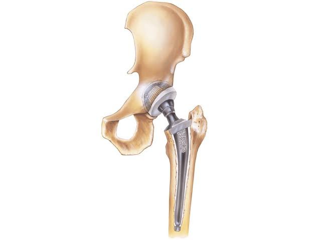 Hip replacement Katni