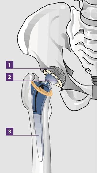Hip replacement Mandla