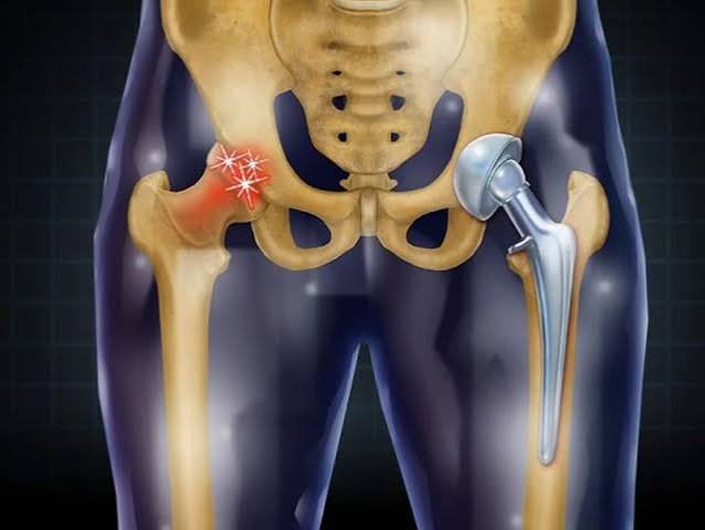 Hip replacement Rewa