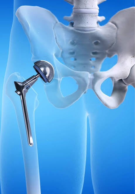 Hip replacement Seoni