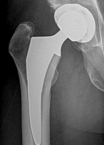 Hip replacement surgery Nagpur