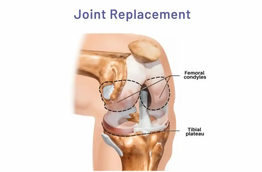 Joint replacement hospital in nagpur