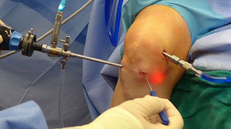 Knee Arthroscopy In Nagpur