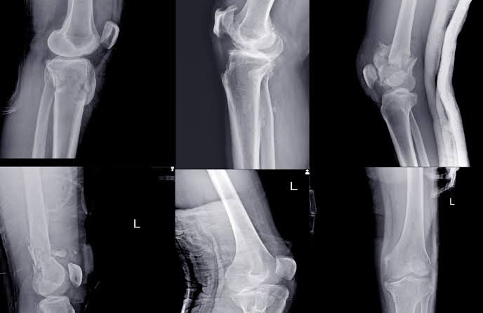 Knee Fracture In Nagpur