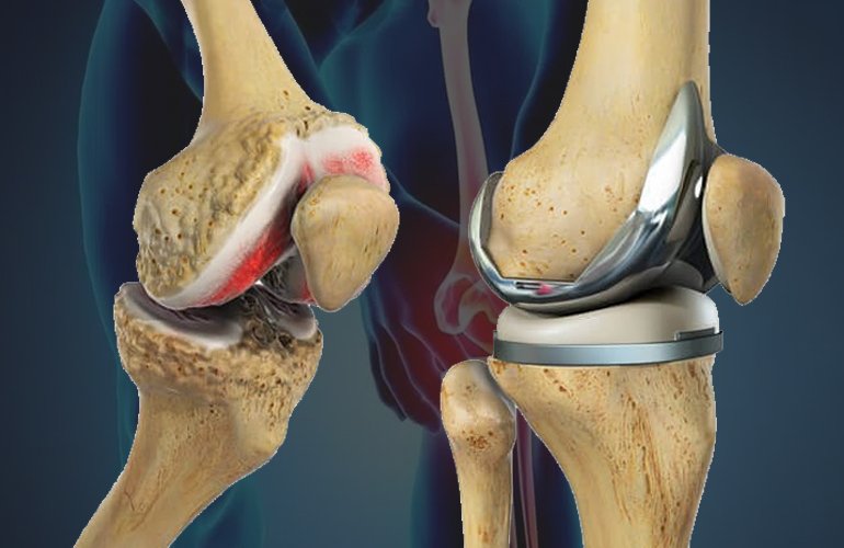 Knee Replacement In Nagpur