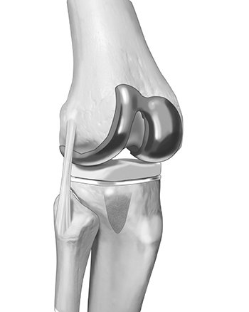 Knee replacement Amaravati