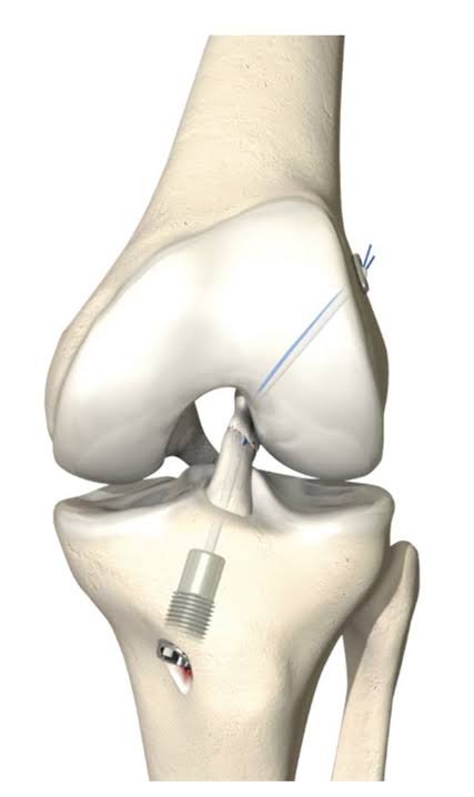 Knee replacement Betul