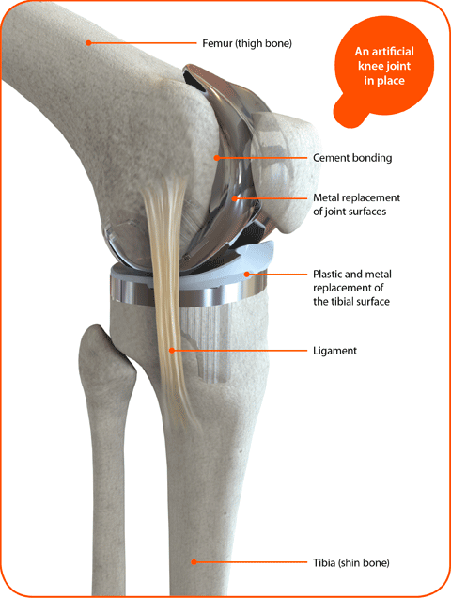 Knee replacement Bhandara
