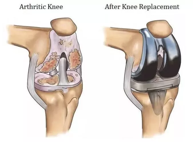 Knee replacement Chandrapur