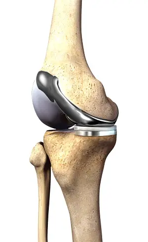 Knee replacement Gadchiroli