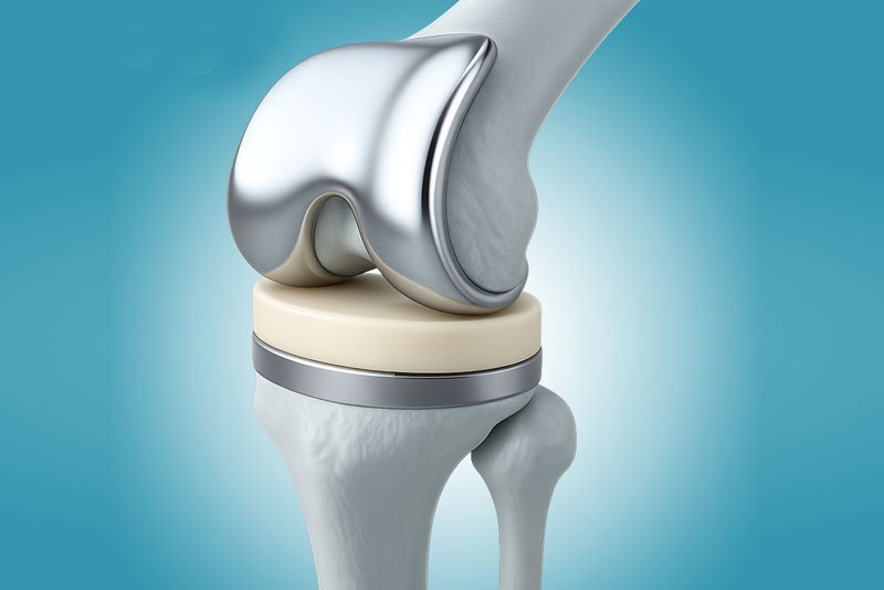 Knee replacement Harda