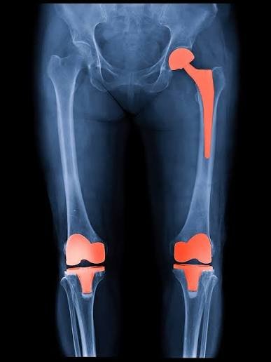 Knee replacement Rewa