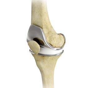 Knee replacement Sagar