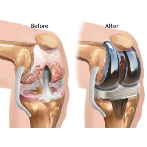 Knee replacement Seoni