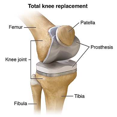 Knee replacement Shahdol