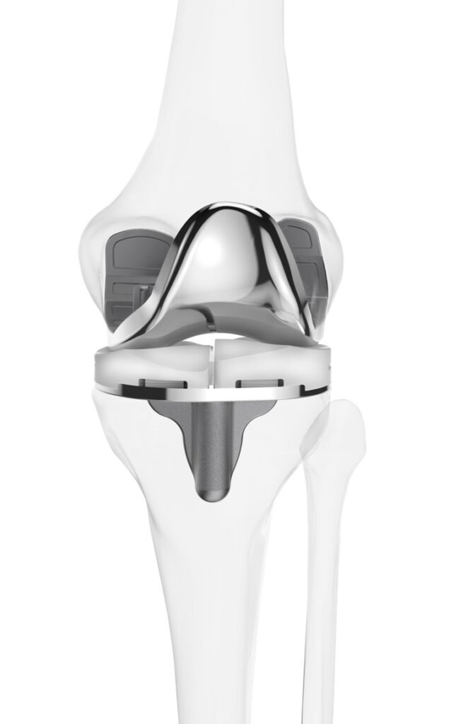Knee replacement Yavatmal