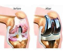 Knee replacement in Satna​
