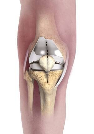Minimally invasive knee replacement Nagpur