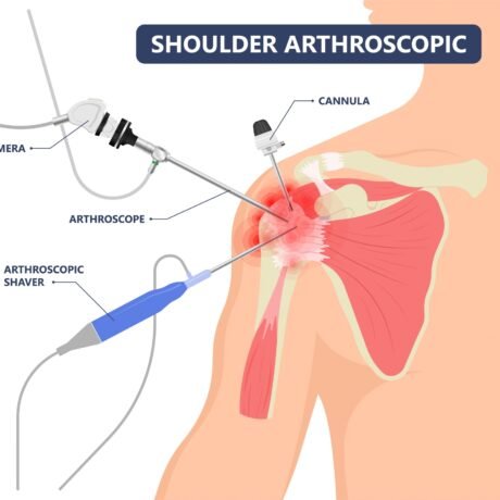 Shoulder arthroscopy in nagpur
