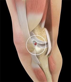 Acl ligament treatment Shahdol