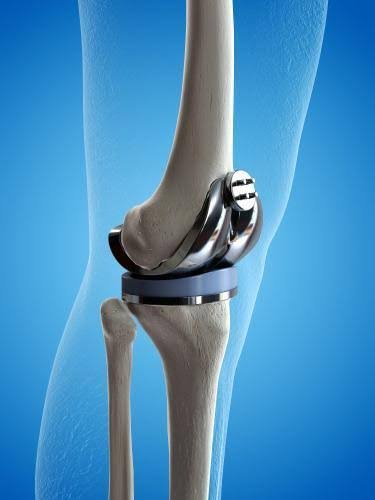 Knee replacement Adilabad